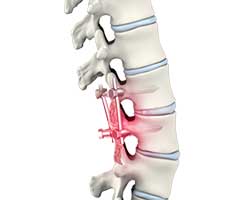 failed back surgery syndrome