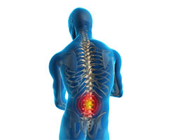 low back pain