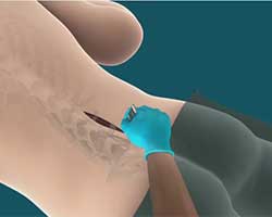 lower back surgery