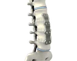 lumbar corpectomy and fusion