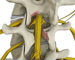 lumbar decompression