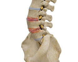 lumbar degenerative disc disease