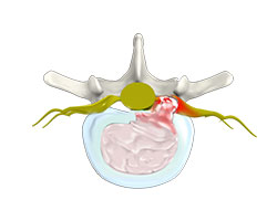 lumbar disc herniation
