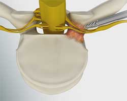 lumbar foraminotom