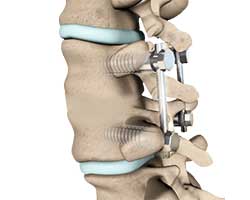 lumbar fusion
