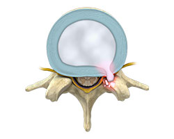 lumbar herniated disc