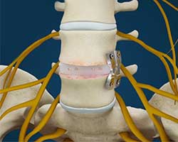 lumbar interbody fusion