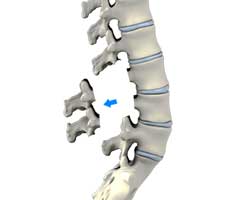 lumbar laminectomy