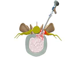 lumbar microdiscectomy