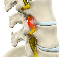 lumbar radiculopathy