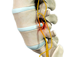 lumbar stenosis