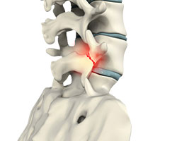 lumbar stress fracture