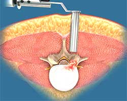 minimally invasive lumbar surgery
