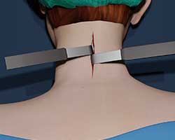 neck surgery