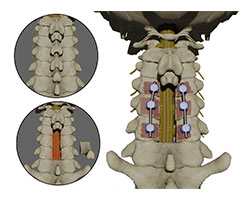 posterior pervical decompression