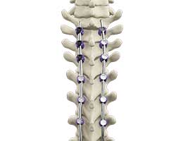 scoliosis surgery