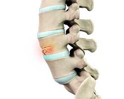 spinal compression fractures