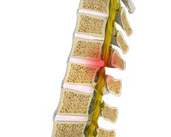 spinal cord compression