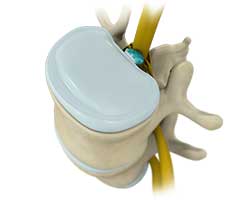 spinal decompression