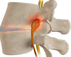spinal stenosis