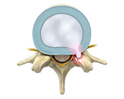 thoracic disc herniation