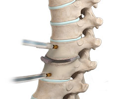 thoracic discectomy