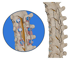 thoracic laminectomy