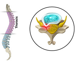 thoracic myelopathy