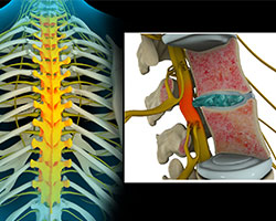 thoracic nerve compression