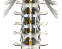 thoracic spinal fusion