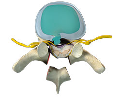 thoracic spine decompression
