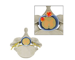 thoracic tumor surgery