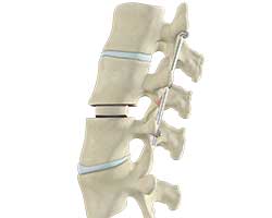 transforaminal lumbar interbody fusion