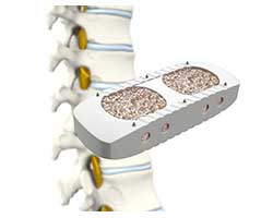 xlif extreme lateral interbody fusion