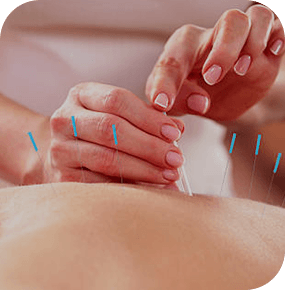 Dry Needling Support for Tight Muscle Areas