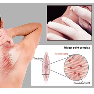 Dry Needling Support for Tight Muscle Areas Sb