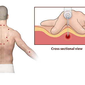 Trigger Point Injection Sb