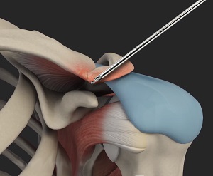 AC Joint Stabilization pic