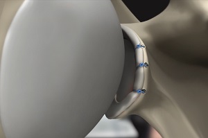 Anterior Shoulder Stabilization pic