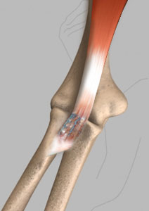 Biceps Tendon Repair pic