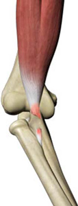 Biceps Tendon Rupture pic