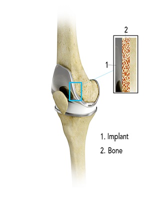 Cementless Total Knee Arthroplasty pic