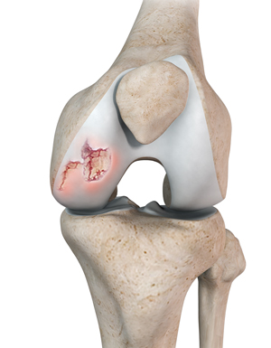 Chondral or Articular Cartilage Defects pic