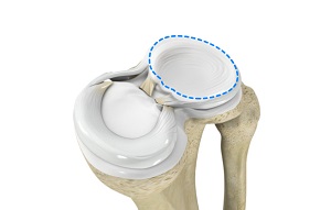 Discoid Meniscus pic
