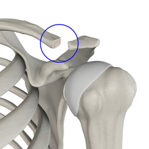 Distal Clavicle Excision pic