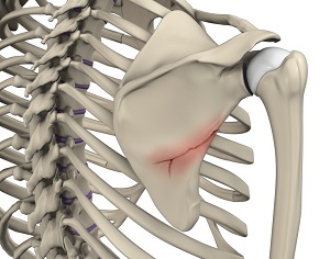 Fracture of the Shoulder Blade (Scapula) pic