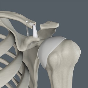 Joint Reconstruction Surgery pic