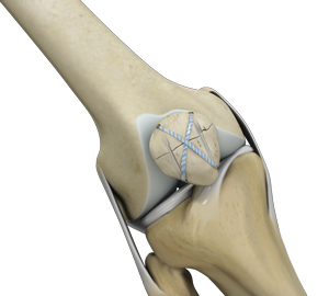 Knee Fracture Surgery pic