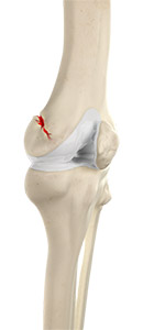 Knee Fracture pic