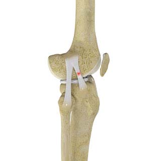 Knee Sprain pic